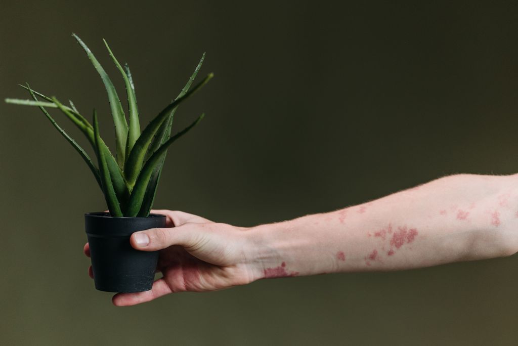 Fotodermatozy – alergia na słońce